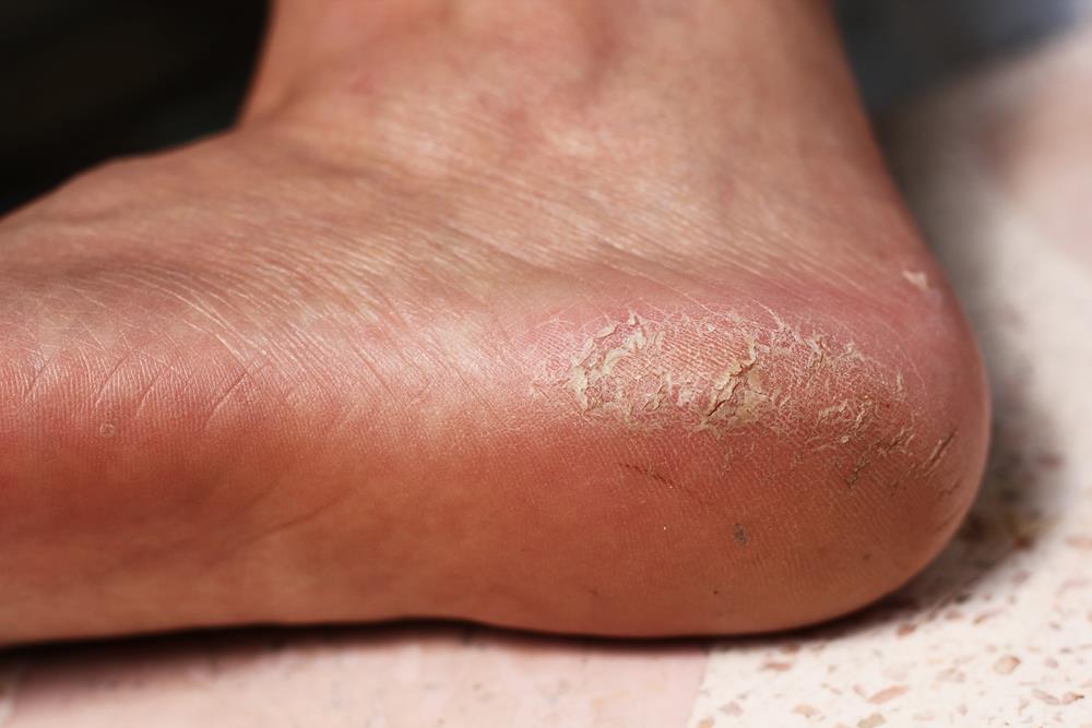 Calluses  Roswell, GA 
