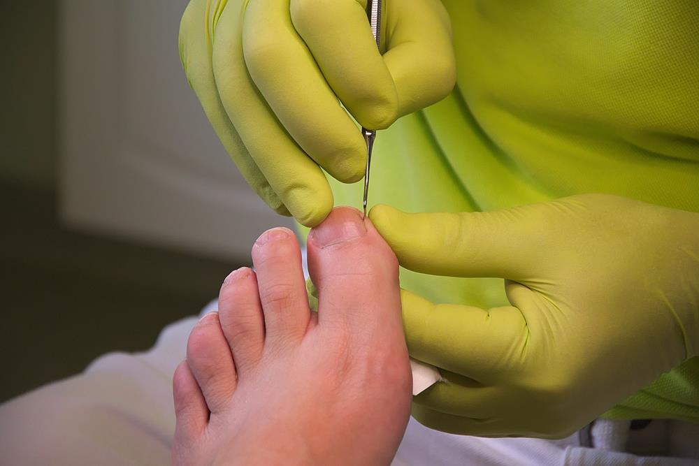 Ingrown Toenails  Roswell, GA 