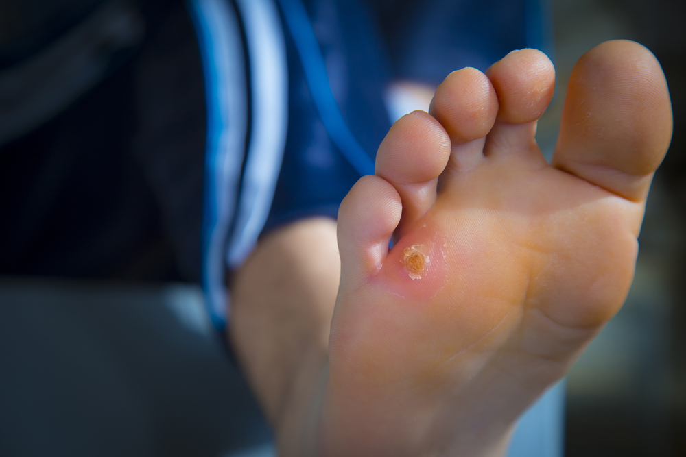 Wound Care Roswell, GA